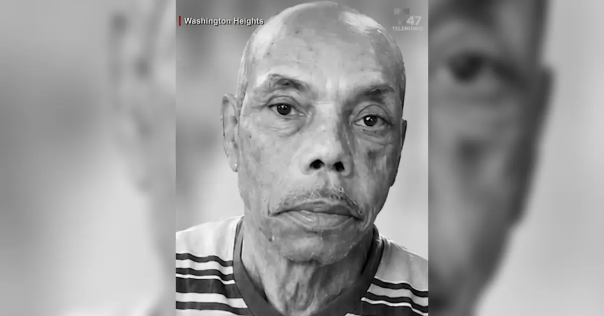 Close-up of a man with severe facial scarring or burns, in grayscale, during a Telemundo Washington Heights news segment, wearing a striped shirt.