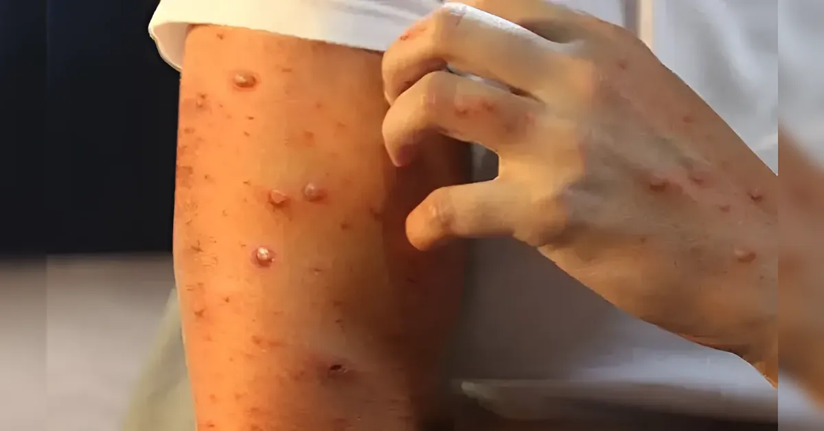 Close-up of a forearm with many small red bumps and blisters, as a hand lifts the sleeve to reveal them (rash on skin).